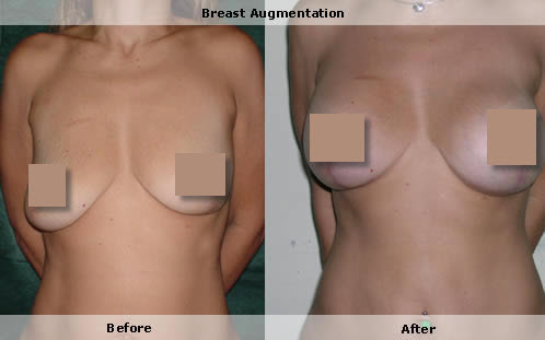 Breast lift, before and after